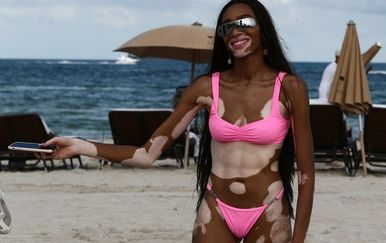 Winnie Harlow (Foto: profimedia)