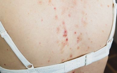 Mehaničke akne: Ove akne nemaju veze s hormonima – evo što ih zapravo uzrokuje i kako se liječe