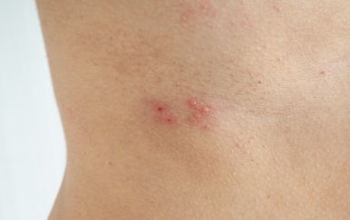 Herpes zoster prijeti ovim ljudima: Jeste li među rizičnim skupinama?