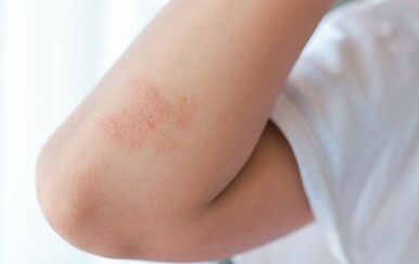 Autoimuni osip: Kad koža otkriva bolest prije nego što se pojave drugi simptomi