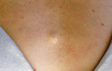 Benigni i maligni tumori: Razlika koja otkriva trebate li se brinuti