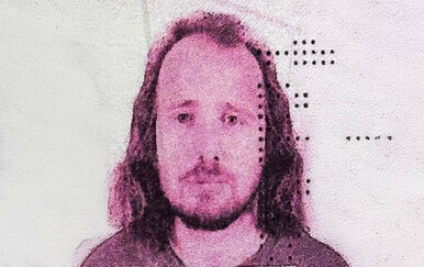 Britanac preminuo nakon transplantacije kose u Turskoj