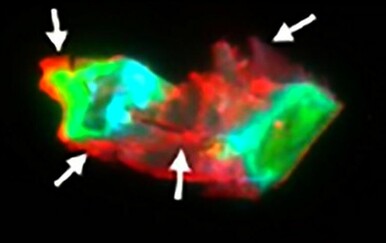 Otkriven ključ trajnih simptoma dugog COVID-a