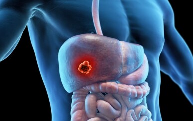 Rak jetre: Uzrok, simptomi, liječenje, prognoza – sve je tu!