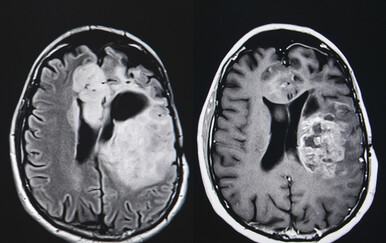 Znanstvenici testiraju kapi za nos koje izravno napadaju jedan od najopakijih tumora