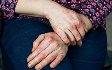 Dishidrotični ekcem: Ovaj tihi kožni poremećaj pogađa sve više ljudi – prepoznajte simptome na vrijeme!