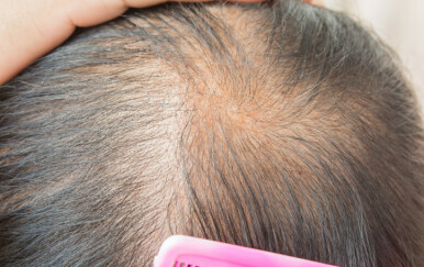 Znanstvenici otkrili formulu? Novi serum vraća kosu u manje od dva mjeseca