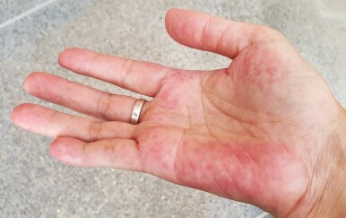 Lupus: Bolest koja napada većinom žene i može se jako zakomplicirati! Evo koji su simptomi