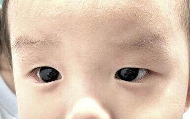 Oči djeteta prije uzimanja lijeka