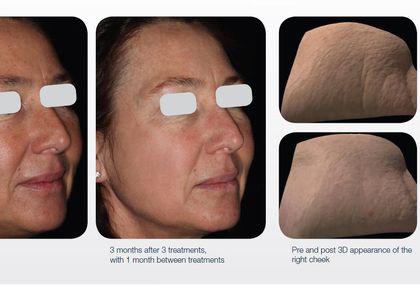 Prije i poslije tretmana laserom LUMENIS M22
