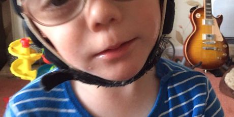 3-godišnji Corey Alway boluje od dva rijetka genetska poremećaja (Foto: Profimedia)