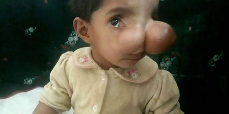 15-mjesečna djevojčica očajnički čeka operaciju koja će joj spasiti život (Foto: Profimedia)