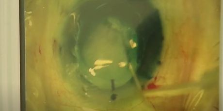 Prva transplantacija rožnice u KBC-u Split - 4