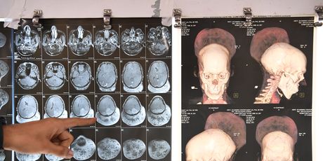 Indijac operirao gotovo dva kilograma težak tumor na mozgu (Foto: AFP) - 2