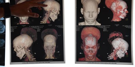 Indijac operirao gotovo dva kilograma težak tumor na mozgu (Foto: AFP) - 3