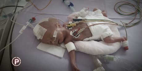 Medicinski uspjeh: najmanja beba preživjela tešku operaciju (Foto: Dnevnik.hr) - 5