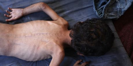 Izgladnjela djeca u Gazi