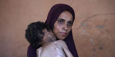 Izgladnjela djeca u Gazi