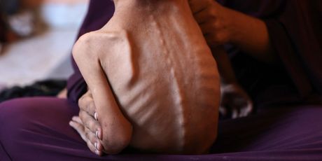 Djeca gladuju u Gazi