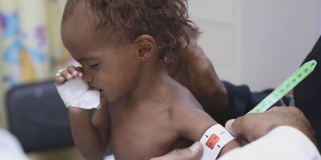 Djeca u Jemenu trebaju pomoć (Foto: Dnevnik.hr) - 2