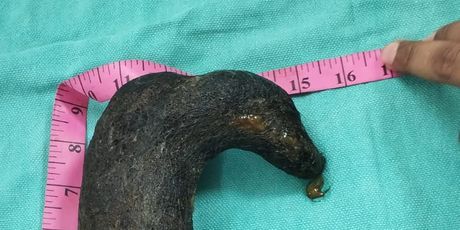 Kirurzi iz želuca 16-godišnjakinje odstranili klupko kose teško pola kilograma - 1