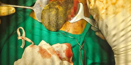Kirurzi iz želuca 16-godišnjakinje odstranili klupko kose teško pola kilograma - 4