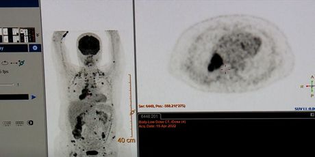 Personalizirano liječenje