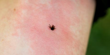 Ubod krpelja (Ilustracija: Getty)