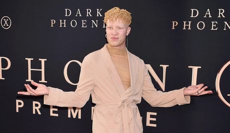 Poznati albino ljudi: 10 slavnih iz glazbe, glume i mode