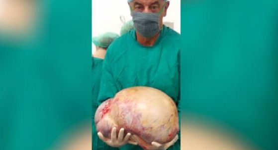 Tumor od 20 kilograma - 1