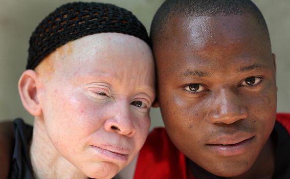 Albinizam u Africi (Ilustracija) - 5