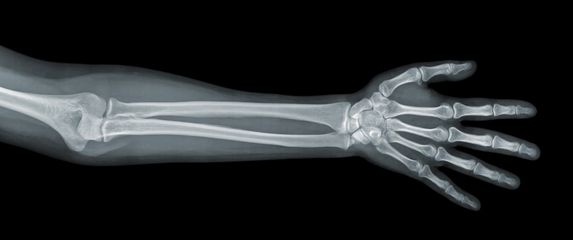 Rentgenska snimka podlaktice, ilustracija