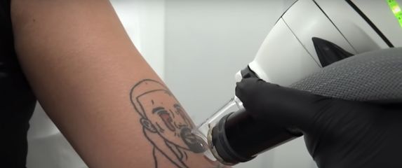 Uklanjanje tetovaži Kanye Westa