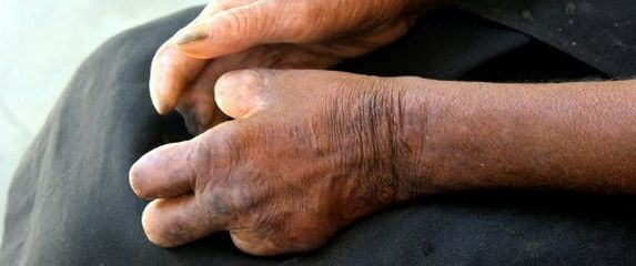 Ruke pacijenta oboljelog od gube