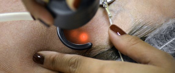 Laserski tretman, ilustracija