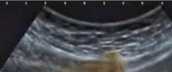 Snimka ultrazvuka sa sarmom u želucu