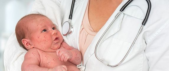 Dijete zaraženo ospicama