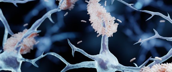 Amiloidni plakovi na neuronima u mozgu, ilustracija