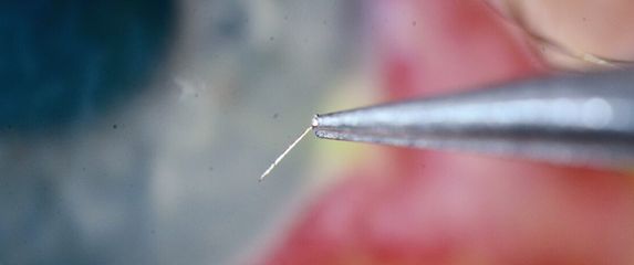 Pčelinji žalac izvađen iz oka