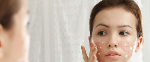 Tretiranje prištića zubnom pastom