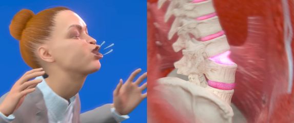 Simulacije ozljede Victorije Kenny koja je kihanje ozlijedila kralježnicu