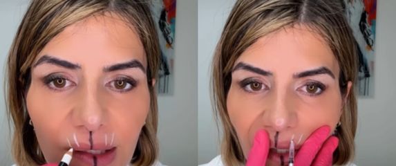 Liječnica koja pokazuje utjecaj botoksa na lice i usne