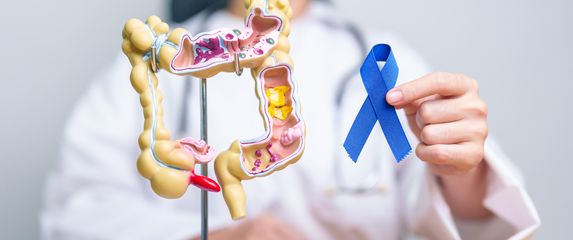 Rak debelog crijeva, ilustracija