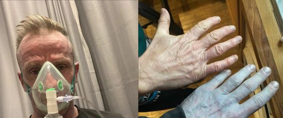 Tommy Lynch i njegovo bizarno plavo stanje