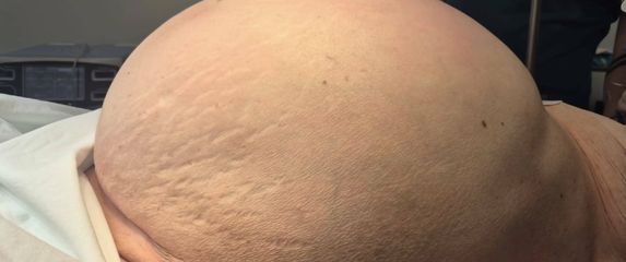 Odstranjen tumor težak 36 kilograma