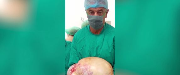Uklonjen najveći tumor u Hrvatskoj