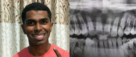 Muškarac iz Malezije Prathab Muniandy i njegovi rekordni zubi