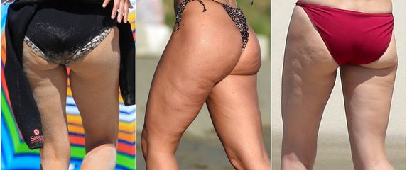 Celulit imaju i najljepše žene svijeta