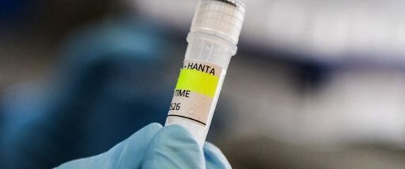 Spremnici koji se koriste za dijagnosticiranje andskog hantavirusa