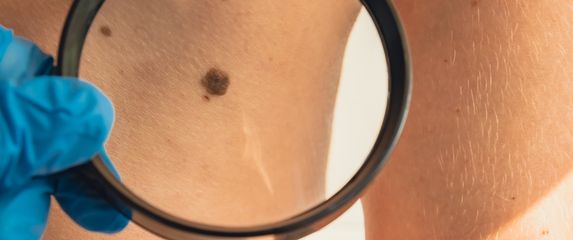 Rak kože, ilustracija